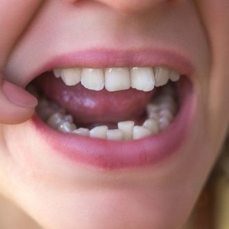 Cosmetic Dentistry For Crooked Teeth in Dubai