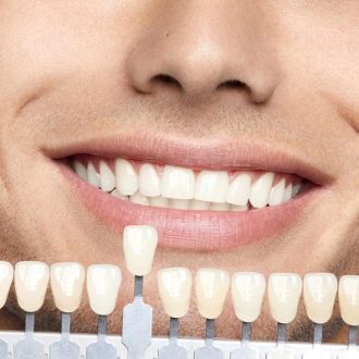 Do Veneers Make You More Attractive in Dubai