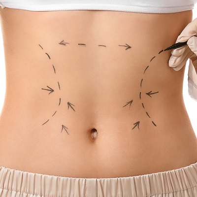Does Laser Lipo Get Rid Of Belly Fat in Dubai & Abu Dhabi Price