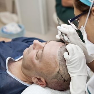 Does a Hair Transplant Cause Cancer in Dubai?