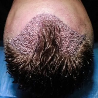 Dubai And Abu Dhabi Best Hair Transplant Center