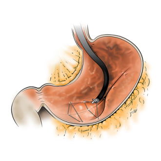 Effects of Surgical Gastric Plication for Weight Loss