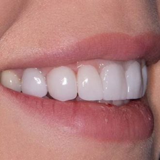 Five Tips For Taking Care of Your Veneers in Dubai