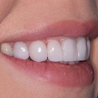 Five Tips For Taking Care of Your Veneers in Dubai & Abu Dhabi Cost