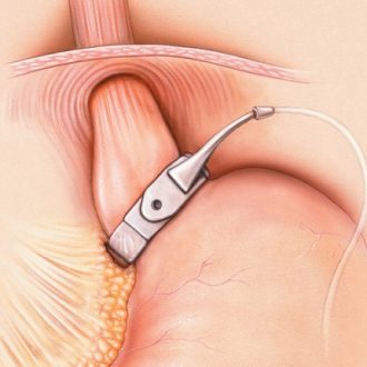 Gastric Banding Cost in Dubai