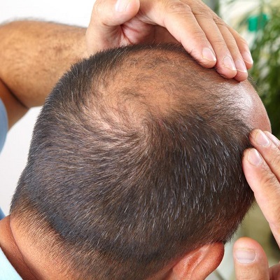 Hair Transplants and the Risk of Nerve Damage
