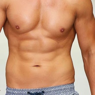 How Long Do Pectoral Implants Last in Dubai?