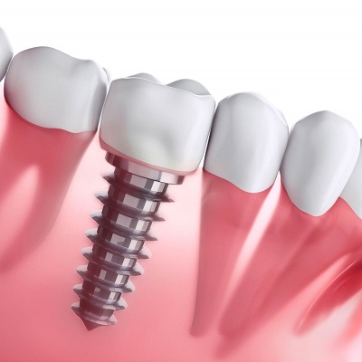 How Long Does it Take to Recover from Dental Implant Surgery in Dubai
