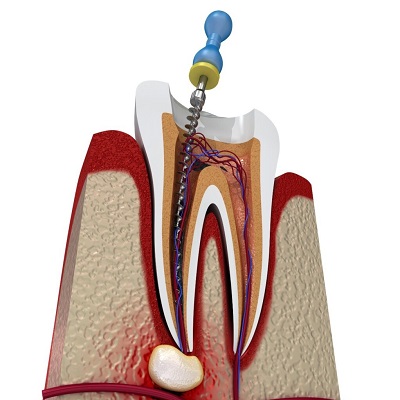 How Root Canals Affect Your Health in Dubai?