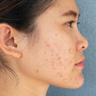 How To Remove Old Scars in Dubai & Abu Dhabi?