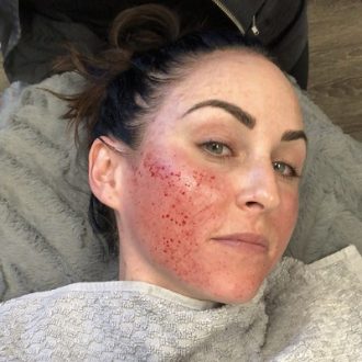 Microneedling For Scars: How Does It Work With RF?