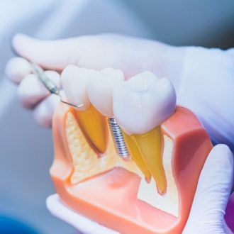 Same Day Dental Implants Cost in Dubai