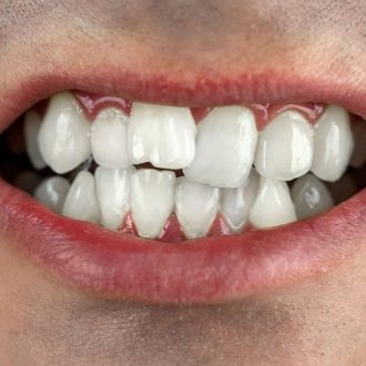 Treatment For Misaligned Teeth in Dubai