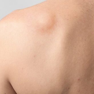 What Is The Best Treatment For Lipoma in Dubai