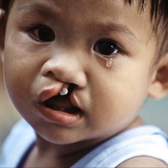 What do You Need To Know About Cleft Lip and Palate?