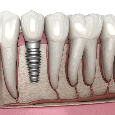 Who Might Need Dental Implants in Dubai?