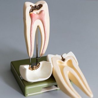 10 Common Misconceptions about Root Canal Treatment