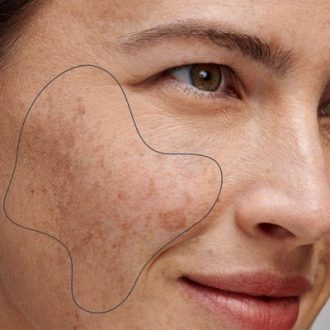 5 Things You Need To Know Before Getting Melasma Treatment