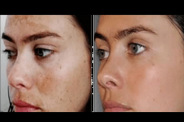 5 Things You Need To Know Before Getting Melasma Treatment in Dubai