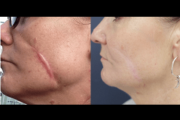 Benefits of Laser Scar Removal in Dubai