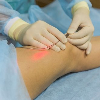 Benefits of Laser Treatment for Varicose Veins