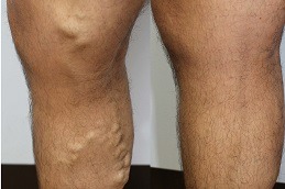 Benefits of Laser Treatment for Varicose Veins in Dubai