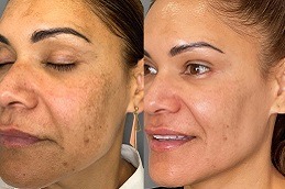 Best 5 Things You Need To Know Before Getting Melasma Treatment Clinic in Dubai