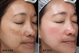 Best 5 Things You Need To Know Before Getting Melasma Treatment in Dubai