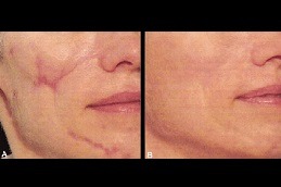 Best Benefits of Laser Scar Removal Clinic in Dubai