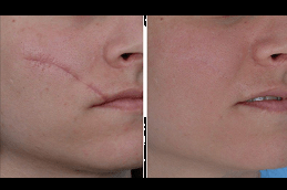 Best Benefits of Laser Scar Removal in Dubai