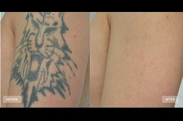 Best Can Picosure Completely Remove Tattoo in Dubai