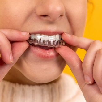 Clear Aligners Cost in Dubai & Abu Dhabi