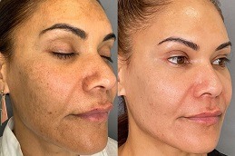 Best Clinic for melasma treatment in Dubai & Abu Dhabi