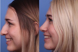 Best Common Steps For A Rhinoplasty Procedure Clinic in Dubai