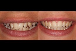 Best Dental Implants For Crooked Teeth Clinic in Dubai