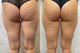 Best Does HIFU Get Rid of Cellulite Clinic in Dubai