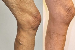 Best Does HIFU Get Rid of Cellulite in Dubai