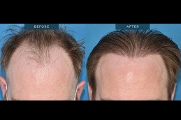 Best Does Hair Transplant Work for Traction Alopecia Clinic in Dubai
