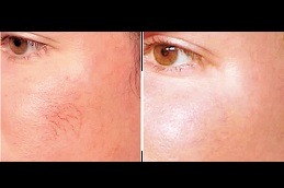 Best Facial Capillaries Causes and Solutions Clinic in Dubai
