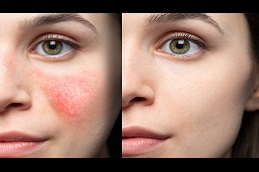 Best Facial Capillaries Causes and Solutions in Dubai