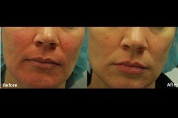 Best Flawless Skin with Morpheus 8 Resurfacing Clinic in Dubai