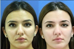 Best Glutathione Injections Is An Antioxidant Shot for Brighter Skin Clinic in Dubai