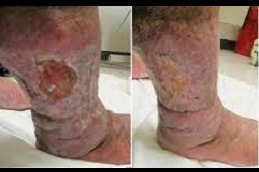 Best Heal for Real Chronic Wound Treatment Options Clinic in Dubai