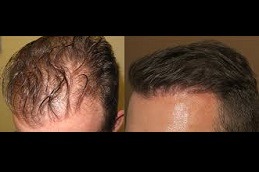 Best How Long do Hair Transplants Take to Grow Clinic in Dubai