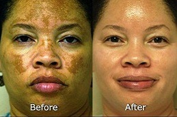 Best How To Remove Pigmentation From Face Permanently Clinic in Dubai