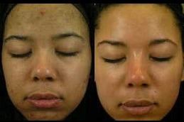 Best How To Remove Pigmentation From Face Permanently in Dubai