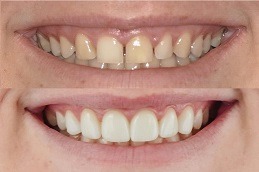 Best How Veneers Can Change Your Life Clinic in Dubai