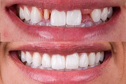 Best How Veneers Can Change Your Life in Dubai