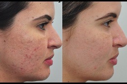 Best How to Choose the Right Melasma Treatment for Your Skin in Dubai