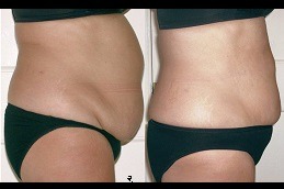 Best Laser Lipolysis Treatment The Future of the Body Contouring in Dubai